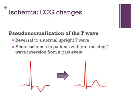 PPT ECG Changes In Myocardial Infarction PowerPoint Presentation