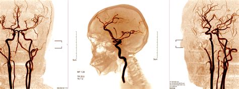 Avm Brain Symptoms