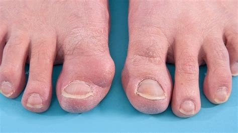 Bunions Vs Gout How Are They Different