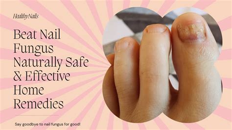 10 Minute Miracle Combat Toenail Fungus Beat Nail Fungus Naturally