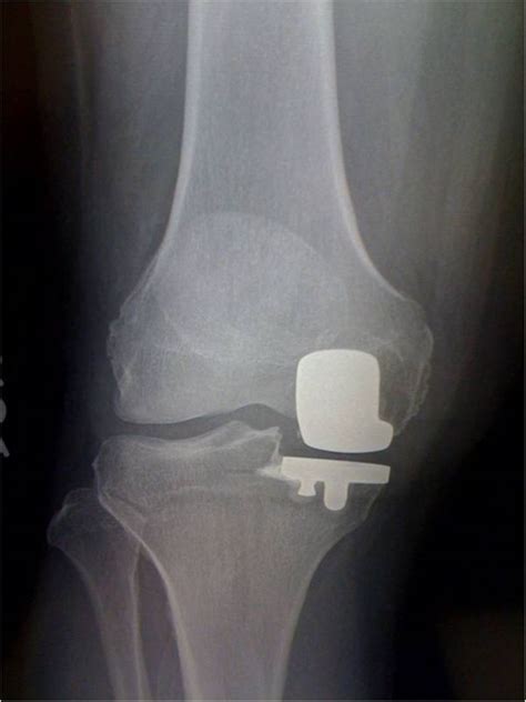 Stryker Triathlon Knee The Strong And Lightweight Knee Extreme