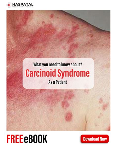 How carcinoid syndrome can affect your health? Haspatal online doctor consultation app ...