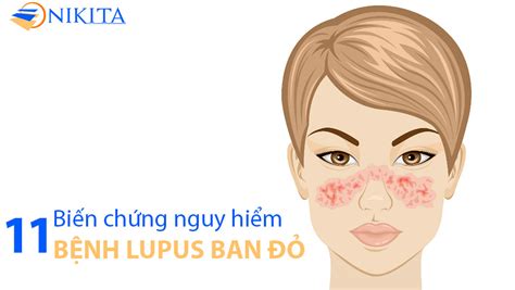 0. Tìm hiểu về bệnh lupus ban đỏ - NIKITA OFFICIAL