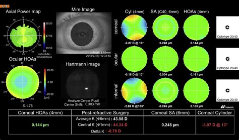 Corneal Topography For Intraocular Lens Selection In Refractive