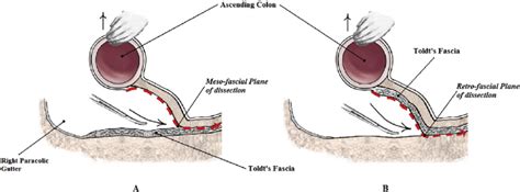 E Schematic Picture Of A Lateral To Medial Approach Generally Used In Download Scientific