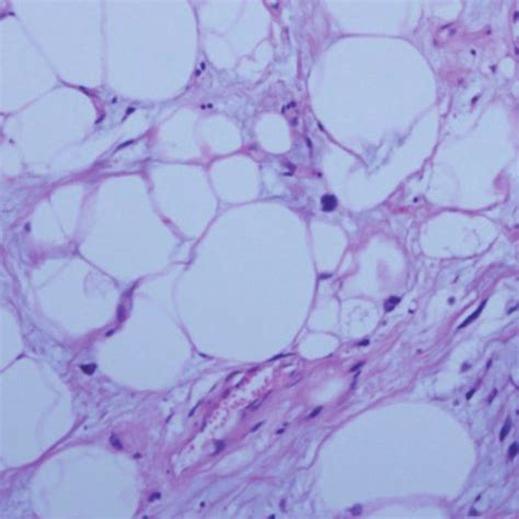 H E Staining Of The Mass Shows Relatively Mature Adipocytes