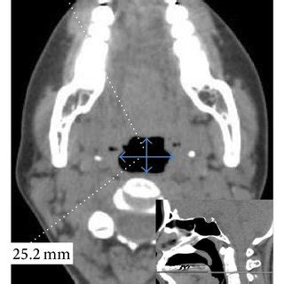 Axial View Computed Tomography Images From Patient A The Narrowing