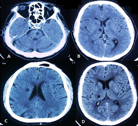 Non Contrast Ct Brain Scans Of Of Our Patients Panel A Belongs To