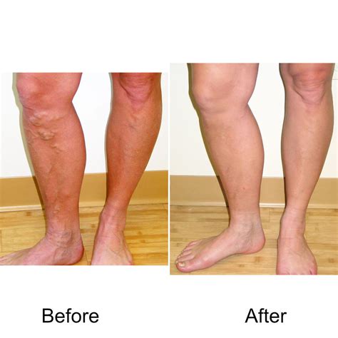 Varicose Vein Treatments Madison Medispa Waunakee