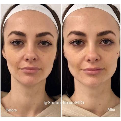 😇non Surgical Face Contouring 🎯 Purpose Augment And Lift The Jawline And Cheeks 👓 How It Work