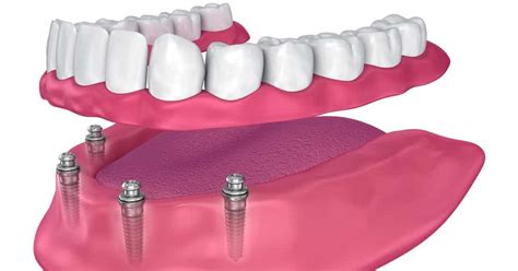 Understanding Implant Overdentures How They Work And Who Can Benefit