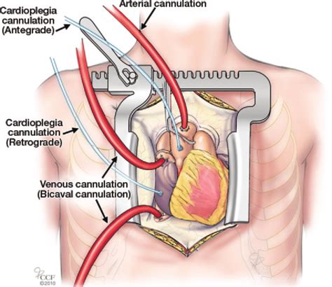 Drawing Shows Several Routes Of Cannulation Arterial Cannulation Of Download Scientific