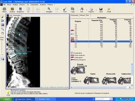 Figure 1 From Accuracy Of Vertebral Fracture Assessment VFA By GE