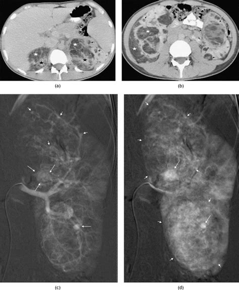 Large Renal Angiomyolipomas Digital Subtraction Angiographic Grading