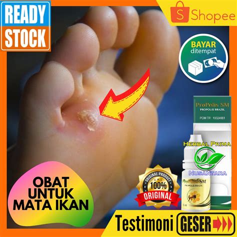 Jual Obat Tetes Oles Mata Ikan Obat Mata Ikan Kaki Telapak Kaki