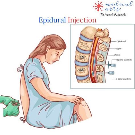 Epidural Injection - Epidural Anesthesia - Video Included – Medical ...