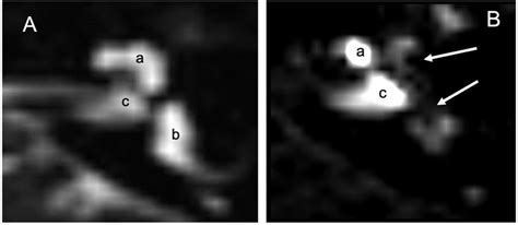 MRI 3 Tesla: (A) MRI in T2 without contrast means: labyrinthine fluids ...