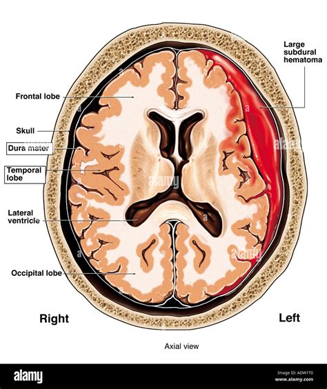 Subdural Hematoma Pathophysiology