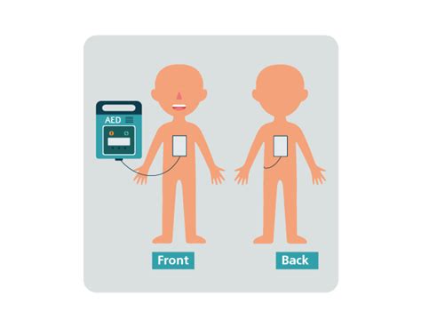 Defibrillator Position And Placement How To Get It Right Steroplast Healthcare