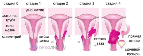 Рак тела матки картинки