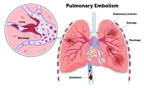 Understanding Pulmonary Embolism Causes Symptoms And Treatment