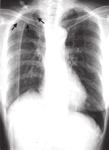 The Chest Radiograph After Right Upper Lobectomy Shows That The