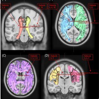 The Process For The Correlation Tractography And Differential