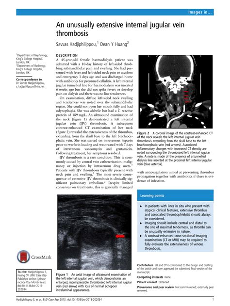 (PDF) An unusually extensive internal jugular vein thrombosis