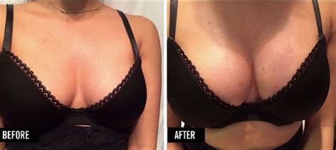 Vampire Breast Lift Prp Covington La Jill Gibson Md