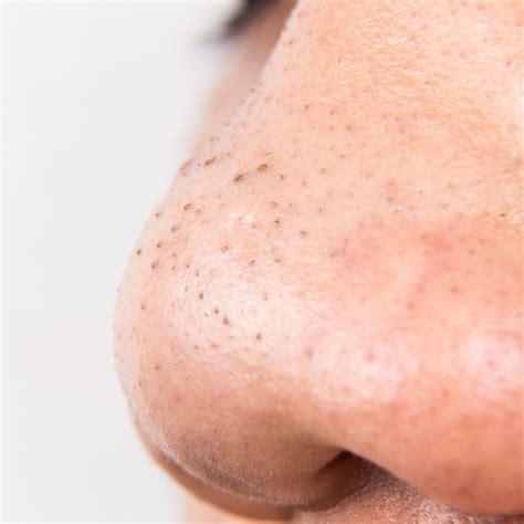 Blackheads And Clogged Pores Are Not The Same Thing What Are