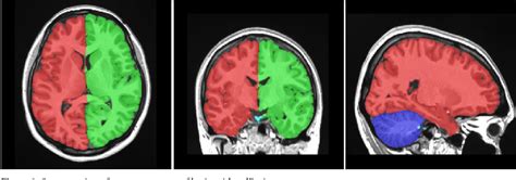 Figure 1 From The Role Of Lateralisation And Sex On Insular Cortex 3d