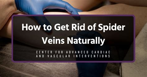 How To Get Rid Of Spider Veins Naturally Vascular Experts In LA