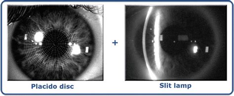 Diagnostic Approach of Corneal Topography Maps | Ento Key