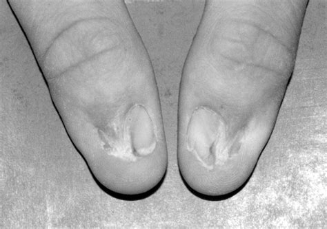 Nail Patella Syndrome Knee