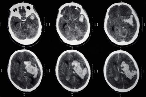 Prediction Algorithm Stratifies Ich Patients At Risk For Hematoma