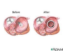 Heart Valve Replacement/Repair | Iowa Heart Center