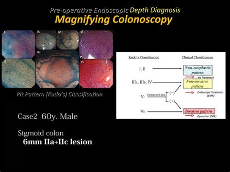 Endoscopy In Gastrointestinal Oncology Slide T Matsuda