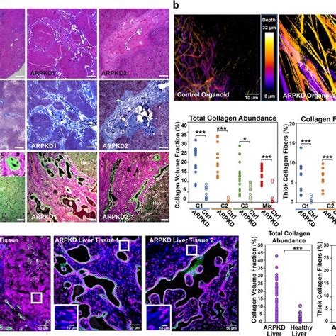 The Pdgfrb Stat Pathway Is Activated In Myofibroblasts In Human Liver