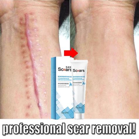 Krim Hilangkan Parut Hilangkan Parut Kaki Acne Scar Removal Cream Body