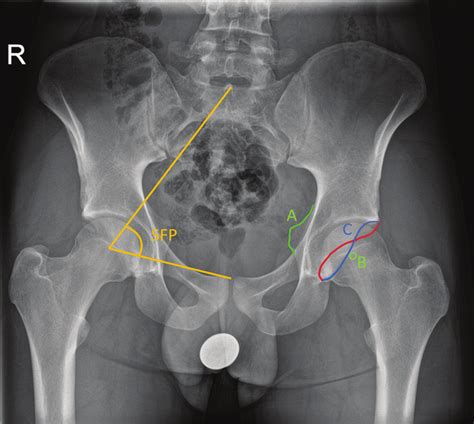 Anteroposterior Pelvic Radiograph Demonstrates Posterior Wall Sign A