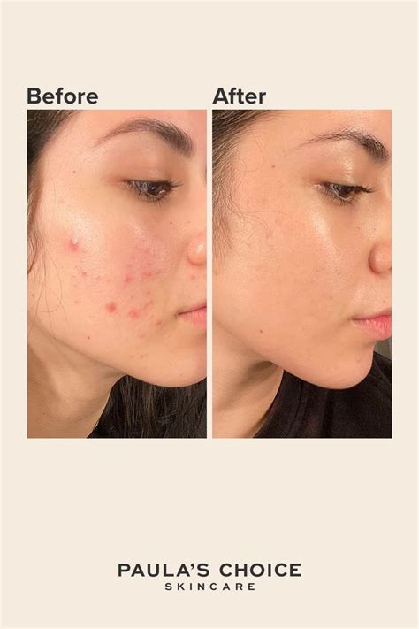 Skin Care Before After Skin Care Uneven Skin Uneven Skin Tone