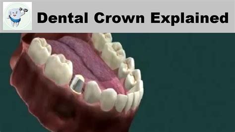 Types of Dental Crowns | Dental Crown Explained - Dental Clinic