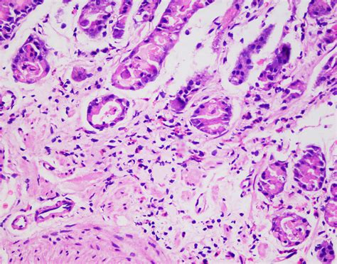 Gastric Biopsy Active Gastritis Download Scientific Diagram