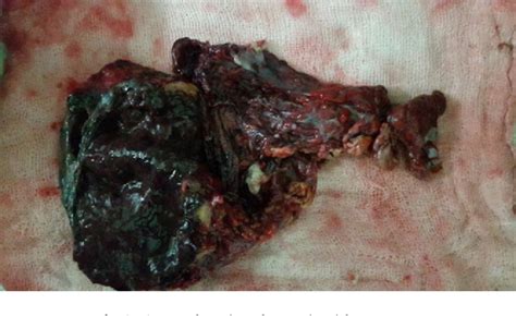 Figure From Primary Omental Gangrene Mimicking Appendicular