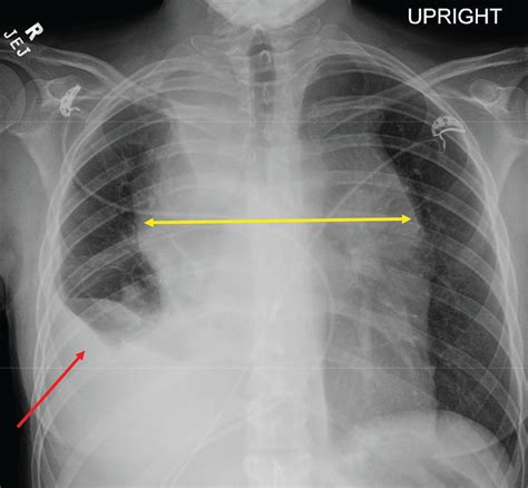 Pleural Effusion X Ray Lateral