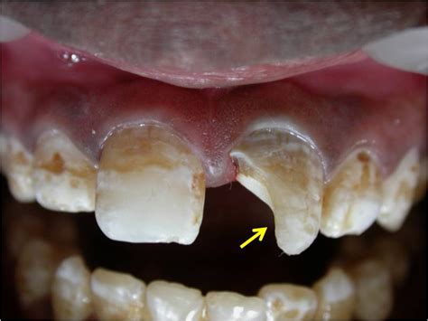 Permanent Maxillary Lateral Incisor With Bifid Canal A Case Report With Literature Review