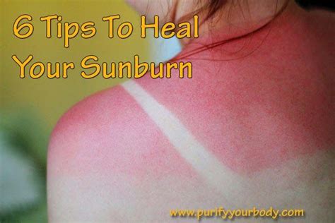 How To Get Relief From A Bad Sunburn 6 Ways To Heal A Sunburn