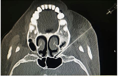 Computed tomography guided puncture to the pterygopalatine fossa to... | Download Scientific Diagram