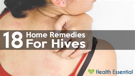 18 Home Remedies To Get Rid Of Hives Fast And Naturally Home Remedies