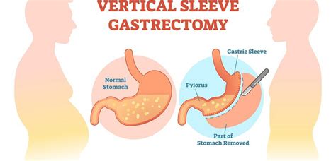 Gastric Sleeve Surgery Is Vertical Sleeve Gastrectomy Right For You